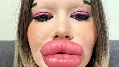 Photo of Woman with world’s biggest lips wants huge cheekbones too