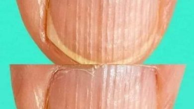 Photo of Rippled fingernails reveal secrets of possible disease